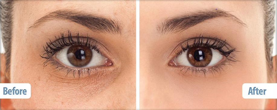 SYN®-AKE có khả năng làm mềm các vết nhăn 52% và giúp giảm các đường “chân quạ” ở mắt tới 24%