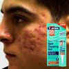 Gel Chấm Mụn T-zone Skincare Spot Zapping Gel 8ml
